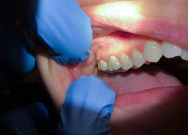 Best Broken or Cracked Tooth Emergency Dentist in Punta Gorda, FL